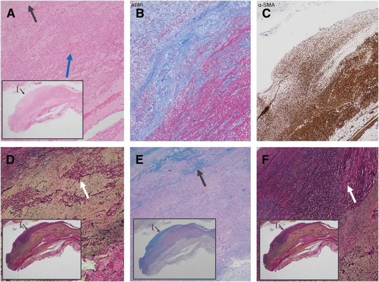 Rapidly Expanding Fusiform Abdominal Aortic Aneurysm without Stenotic Lesion Caused by Fibromuscular Dysplasia: A Rare Case.