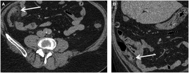 Appendiceal diverticulitis: a rare pathology disguised as acute appendicitis.