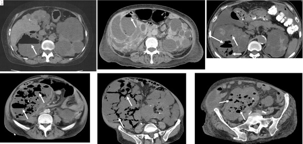 Treatment of emphysematous polycystic renal infection in patients with autosomal dominant polycystic kidney disease: Feasibility and limitations of percutaneous cyst drainage.