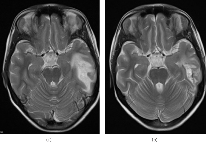 Aseptic Meningitis and White Matter Disease in Childhood-Onset Neuropsychiatric Lupus.