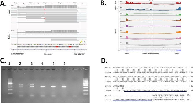 A deep intronic <i>PHEX</i> variant associated with X-linked hypophosphatemia in a Finnish family.