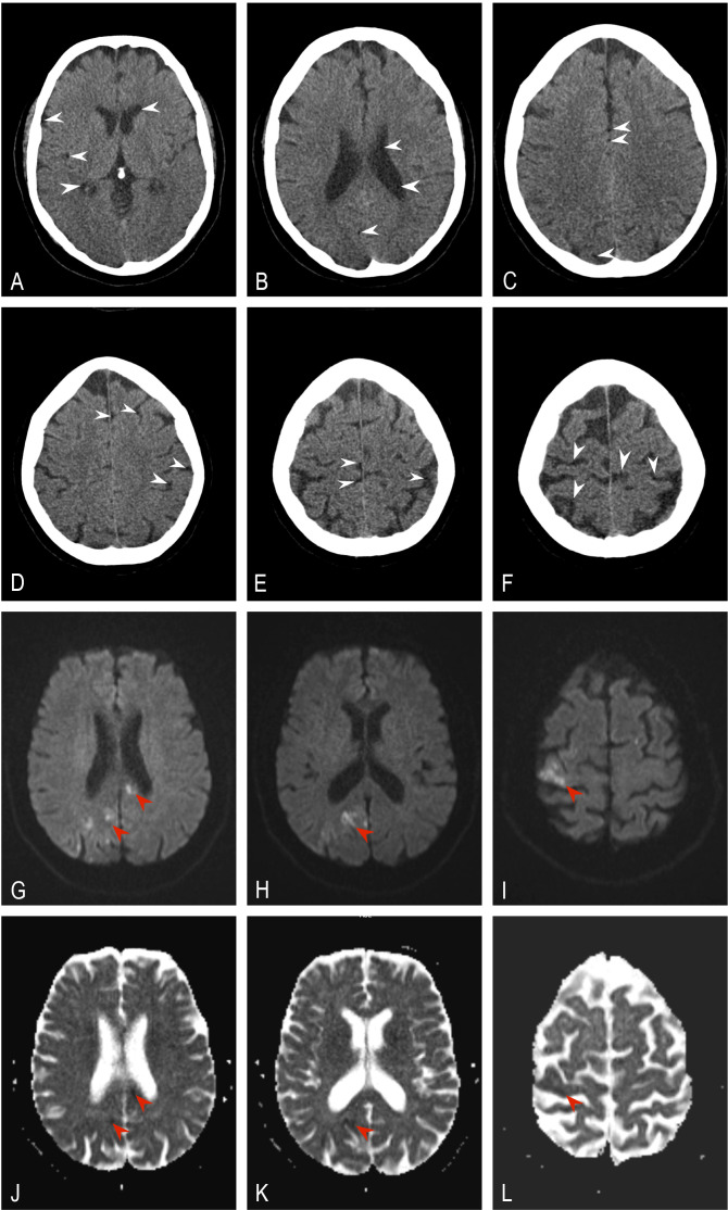 Cerebral gas embolism and multifocal ischemic stroke during oxygen-ozone therapy: a case report.