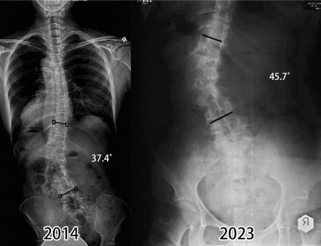 Impact of scoliosis-specific exercises in moderate to severe thoracolumbar curves in three postmenopausal women.
