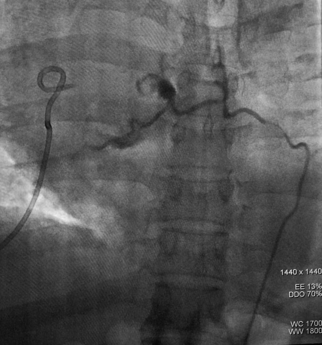 Bronchial artery pseudoaneurysm presenting with hemoptysis and hemothorax after pulmonary lobectomy: a case report and literature review.