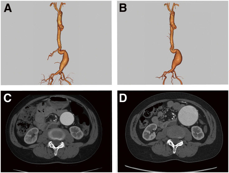 Rapidly Expanding Fusiform Abdominal Aortic Aneurysm without Stenotic Lesion Caused by Fibromuscular Dysplasia: A Rare Case.
