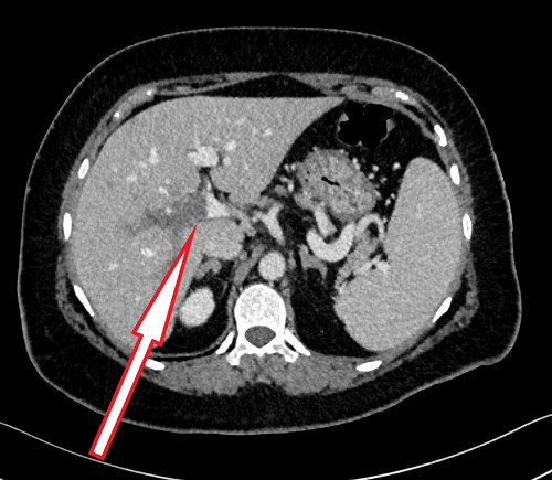 Portal vein thrombosis in a patient on semaglutide.