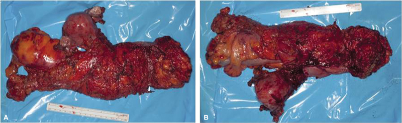Robotic Multivisceral Resection (RMVR) of the Pelvis for Locally Advanced Colorectal Carcinoma: Single Oncosurgical Center Experience.