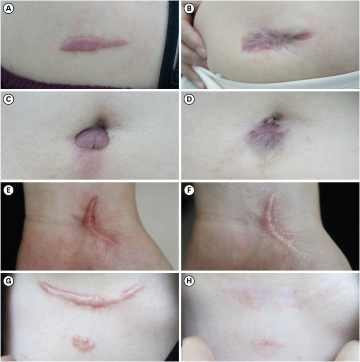 Assessment of Treatment Modalities in Patients With Keloids: A Vancouver Scale Comparison.