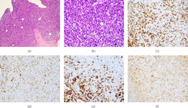 Acute Myeloid Leukemia (AML) With T-Cell Differentiation Arising From Chronic Myelomonocytic Leukemia (CMML).