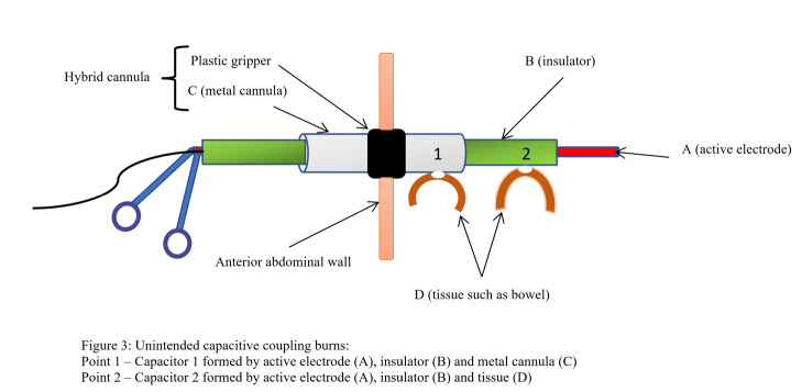 Complications of electrosurgery: mechanisms and prevention strategies.