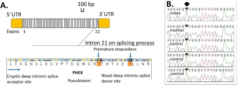 A deep intronic <i>PHEX</i> variant associated with X-linked hypophosphatemia in a Finnish family.