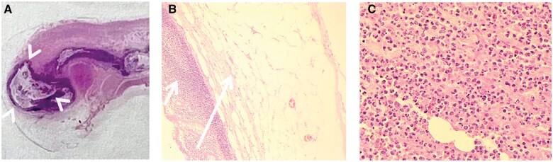 Appendiceal diverticulitis: a rare pathology disguised as acute appendicitis.