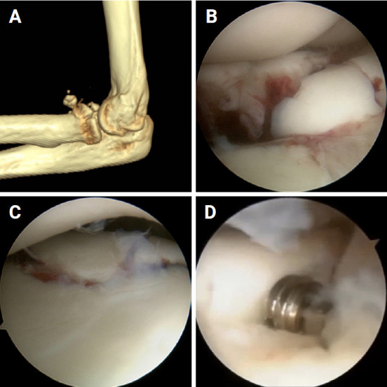 Is partial excision of the radial head safe and effective in all-arthroscopic treatment of terrible triad fractures?