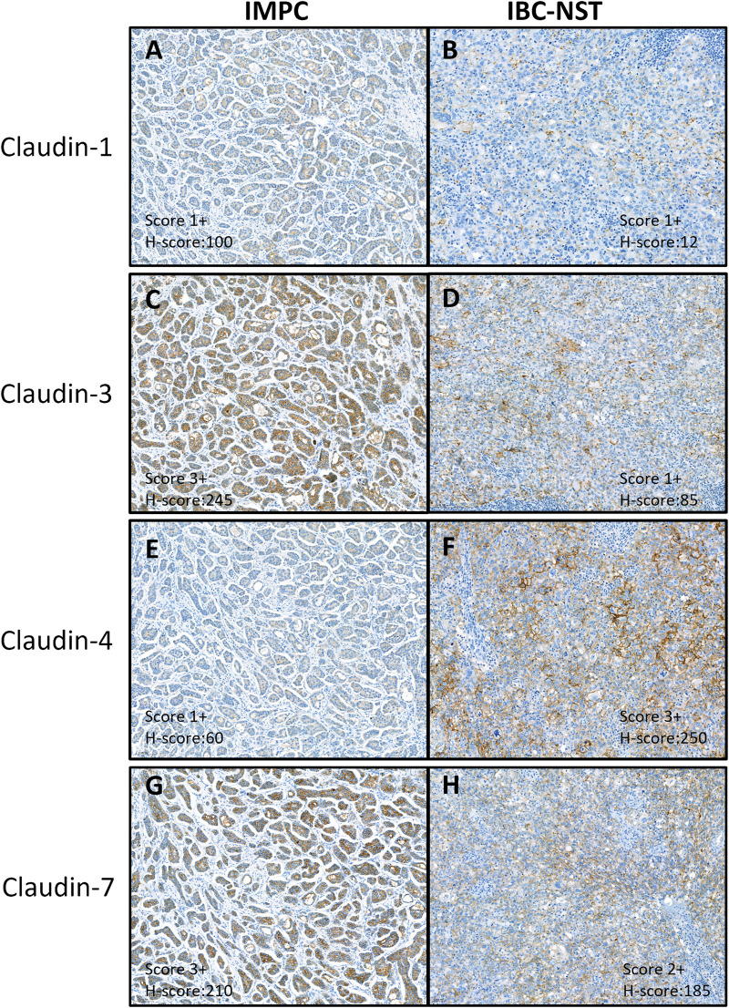 Invasive micropapillary carcinoma of the breast and invasive breast carcinoma of no special type: a comparison of claudin proteins' expression and its impact on survival.