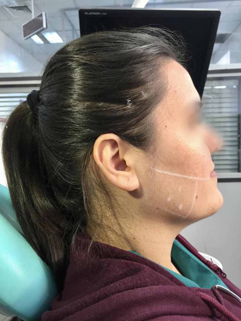 Comparison of the effectiveness of botulinum toxin, dry needling, pharmacological treatment, and manual therapy for bruxism-induced myalgia: a prospective randomized study.