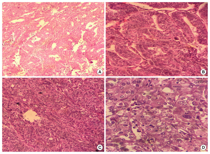 Association of stromal tumor-infiltrating lymphocytes with clinicopathological parameters in endometrial cancer.