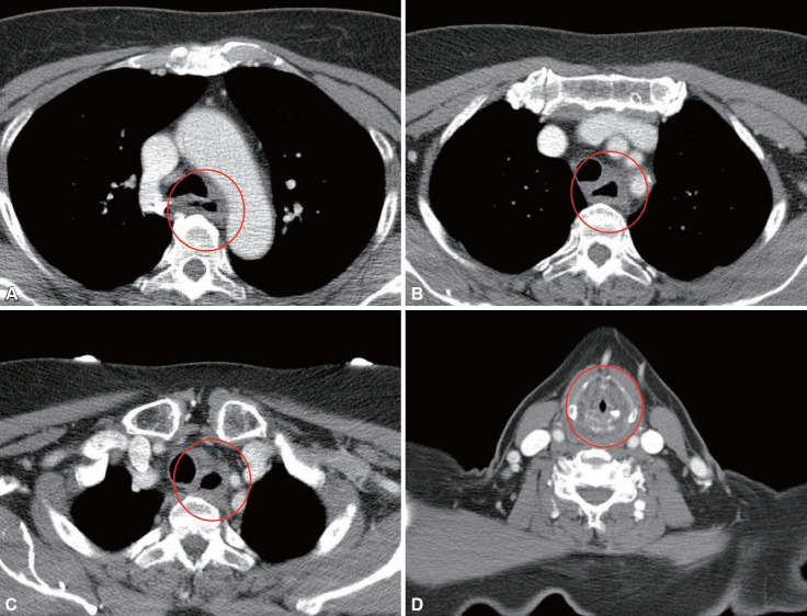 Severe Corrosive Injury Secondary to Chlorine Bleach Ingestion: A Case Report.
