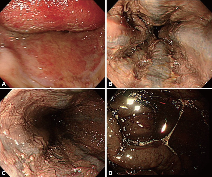 Severe Corrosive Injury Secondary to Chlorine Bleach Ingestion: A Case Report.