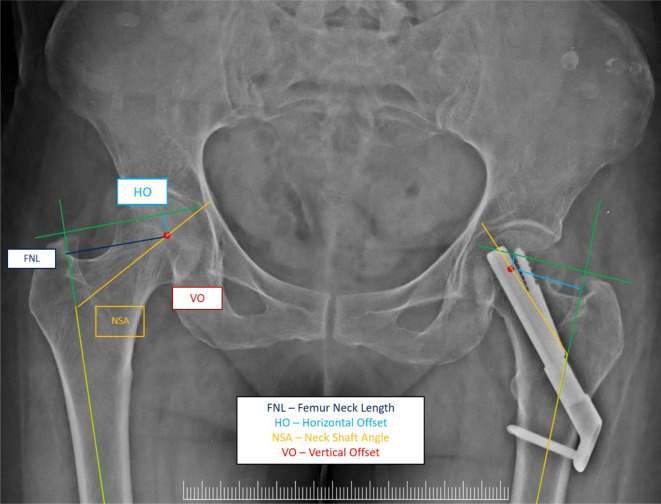 Difference of Neck Shortening in Femoral Neck Fracture between Femoral Neck System and Multiple Cannulated Cancellous Screws: Single Center, Prospective Randomized Controlled Trial.