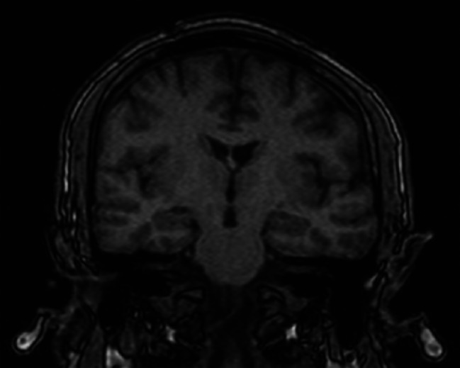 Can dissociative amnesia be a residual symptom of prolonged complex post-traumatic stress disorder?