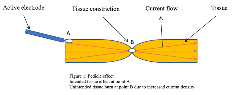 Complications of electrosurgery: mechanisms and prevention strategies.