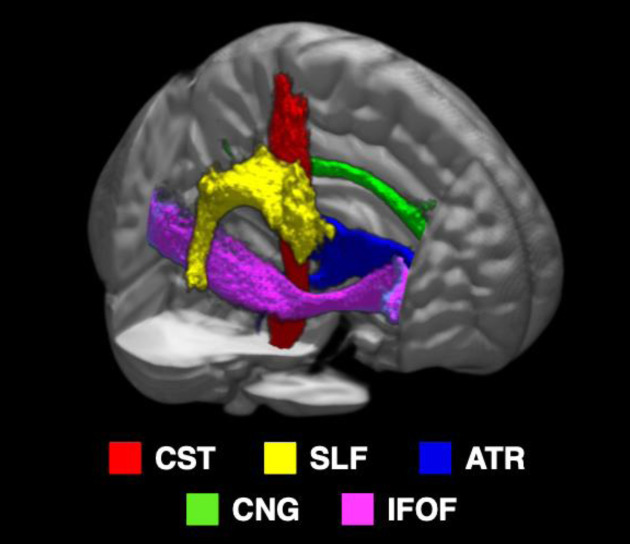 Brain regions associated with balance function assessed by the Berg Balance Scale in post-stroke patients.