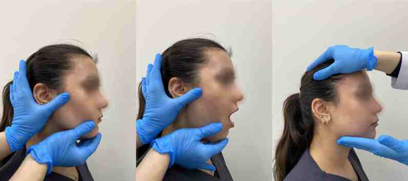 Comparison of the effectiveness of botulinum toxin, dry needling, pharmacological treatment, and manual therapy for bruxism-induced myalgia: a prospective randomized study.