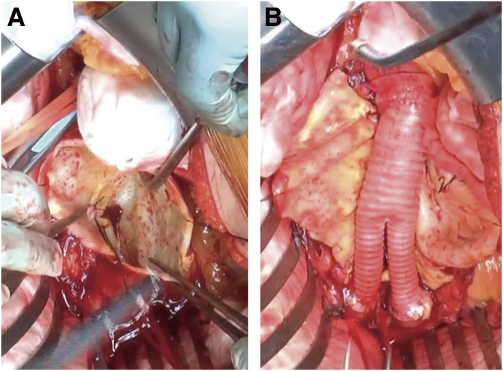Rapidly Expanding Fusiform Abdominal Aortic Aneurysm without Stenotic Lesion Caused by Fibromuscular Dysplasia: A Rare Case.
