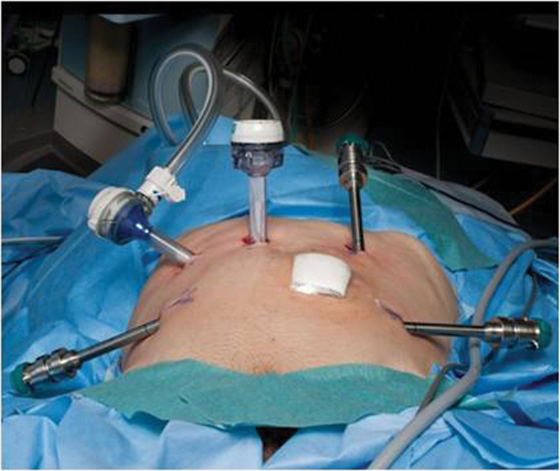 Robotic Multivisceral Resection (RMVR) of the Pelvis for Locally Advanced Colorectal Carcinoma: Single Oncosurgical Center Experience.