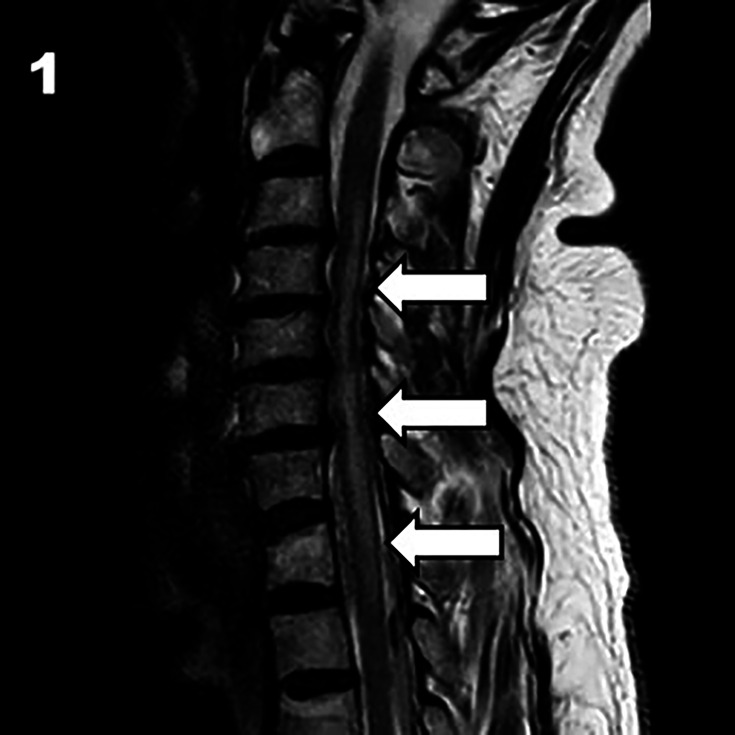 Systemic intravenous thrombolysis and spinal stroke: a case report and review of the literature.
