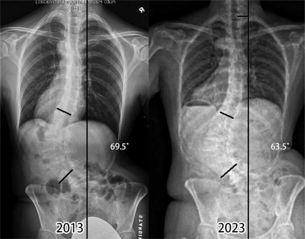Impact of scoliosis-specific exercises in moderate to severe thoracolumbar curves in three postmenopausal women.