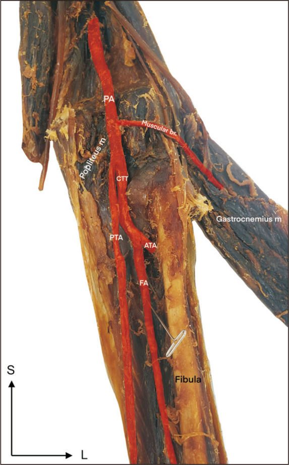 A rare variation in popliteal artery branching: anterior tibial artery and fibular artery from the common tibiofibular trunk.