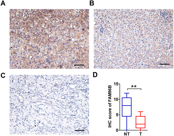 Low Expression of FAM96B is Associated with Poor Prognosis in Hepatocellular Carcinoma.