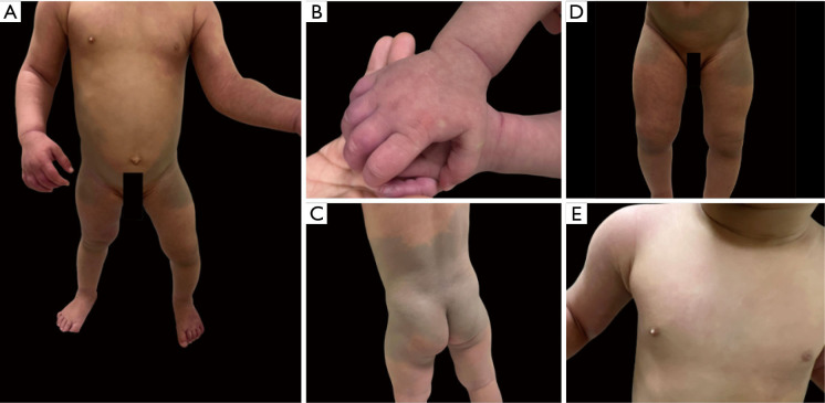 Phakomatosis pigmentovascularis type 2a: a rare case report.