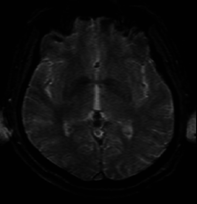Can dissociative amnesia be a residual symptom of prolonged complex post-traumatic stress disorder?
