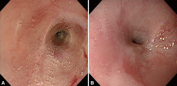 Severe Corrosive Injury Secondary to Chlorine Bleach Ingestion: A Case Report.