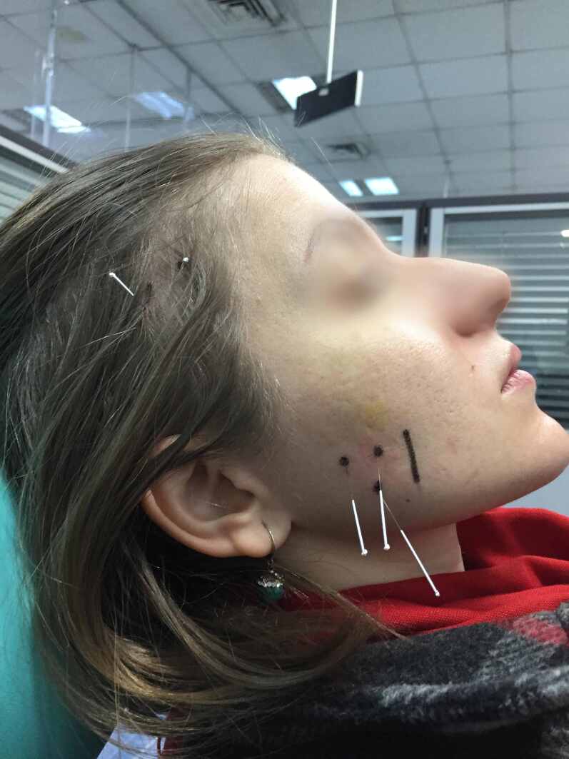 Comparison of the effectiveness of botulinum toxin, dry needling, pharmacological treatment, and manual therapy for bruxism-induced myalgia: a prospective randomized study.
