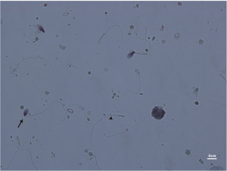 Pathogenesis of acephalic spermatozoa syndrome caused by PMFBP1 mutation.