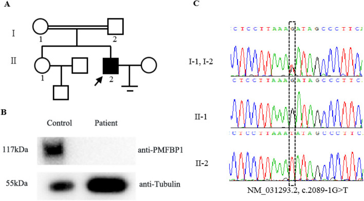 Pathogenesis of acephalic spermatozoa syndrome caused by PMFBP1 mutation.