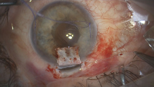 Ab externo Schlemm's canal surgery: Efficacy and safety outcomes.