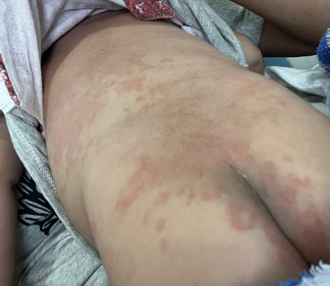Overcoming the Challenges of Intravenous Immunoglobulin Resistance in Kawasaki Disease: A Case Report.