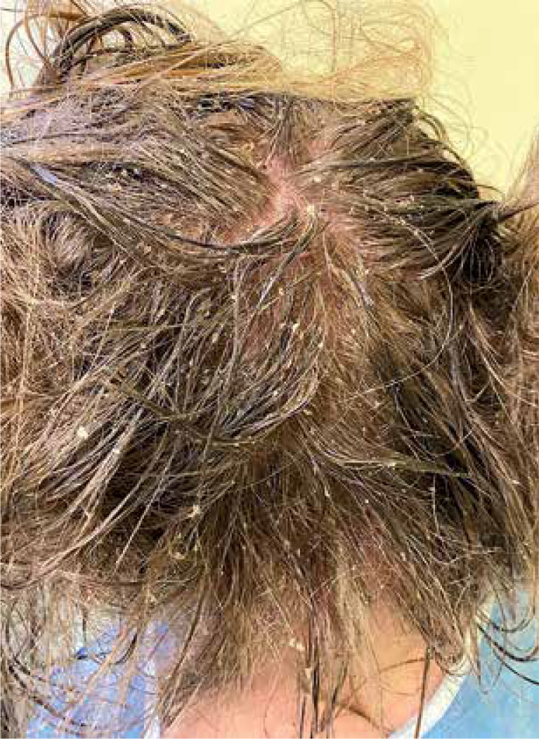 Rare complications of pediculosis capitis.