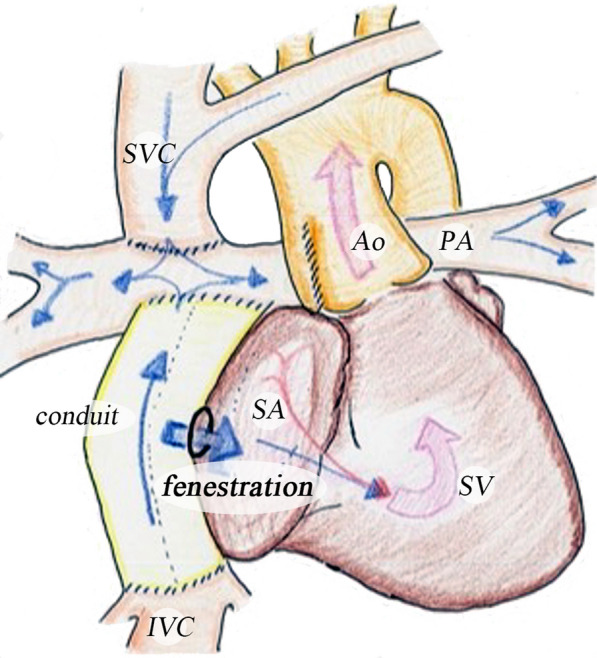 Evaluation of the effects of fenestration in Fontan circulation using a lumped parameter model.