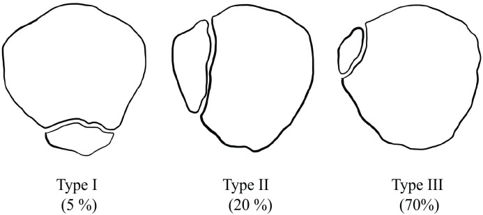 Treatment of symptomatic bipartite patella in patients <21 years of age: A systematic review and treatment algorithm.