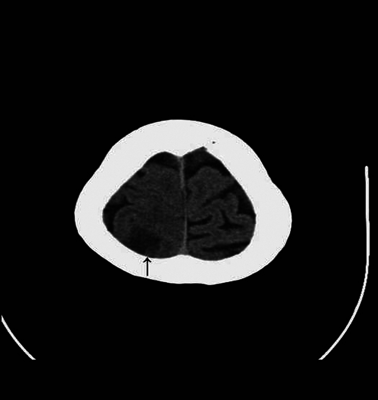 A Rare Case of Dual Primary Supratentorial Glioma and Infratentorial Meningioma.