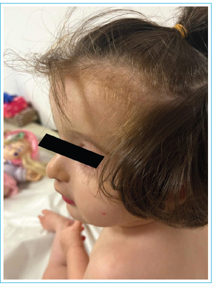Drayer Syndrome due to Chromosome 15q26.3 Deletion: Response to Growth Hormone Treatment.