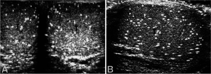 Is testicular microlithiasis associated with decreased semen parameters? a systematic review.