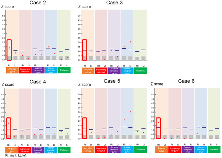 Case series of patients with early psychosis presenting hypoperfusion in angular gyrus and self-disturbance: Implication for the sense of agency and schizophrenia.