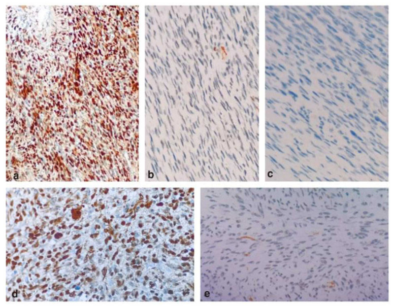 Cellular Schwannoma of the Palate Simulating as Malignant Peripheral Nerve Sheath Tumor: A Diagnostic Marathon.