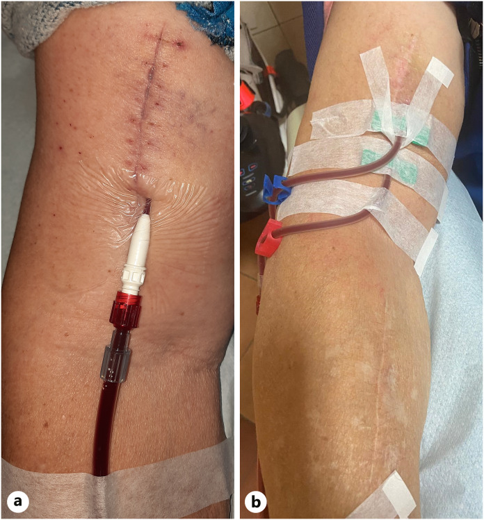 The Forearm's Subcutaneous Venous Network to Accelerate Maturation of Native Arteriovenous Fistula: A Case Report.
